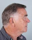After Hair Transplant&nbsp;Front